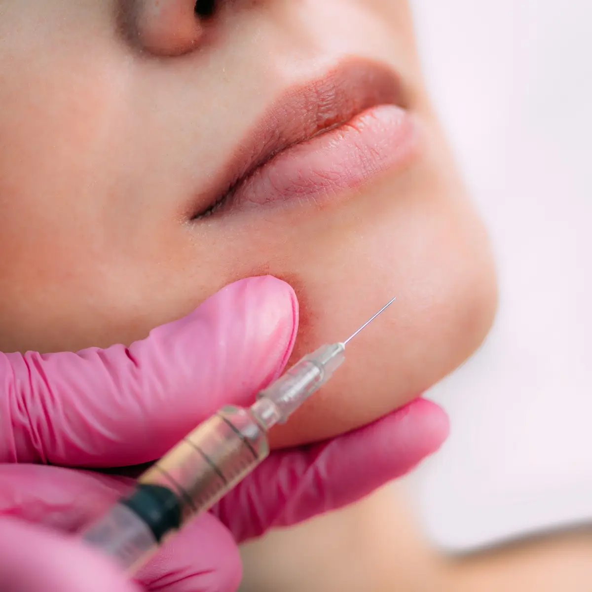 Volumizing Juvéderm® in Celebration, FL | IAS