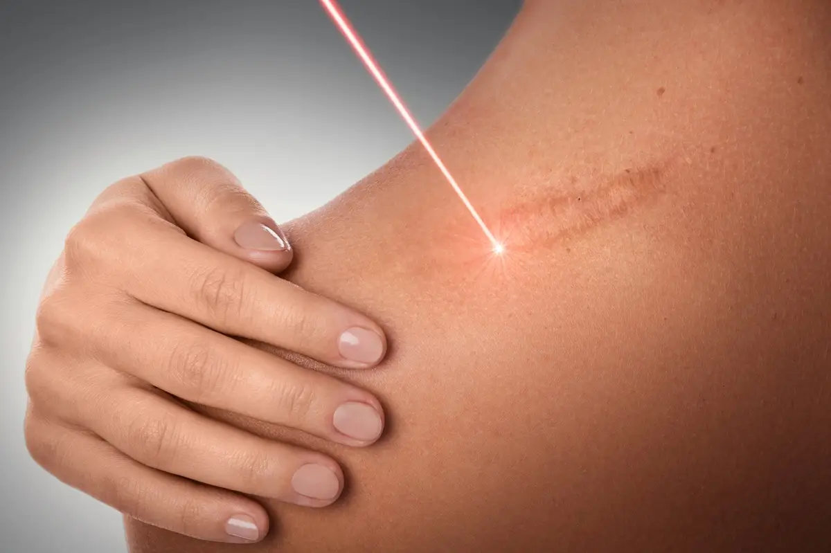 Scar Revision Surgery