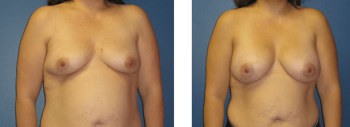 Breast Augmentation Before &#038; After