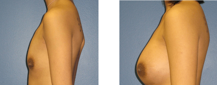 Breast Augmentation Before &#038; After