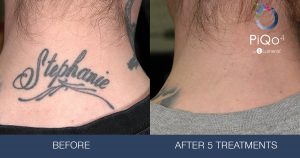 efore&afterlaser tatto removal2