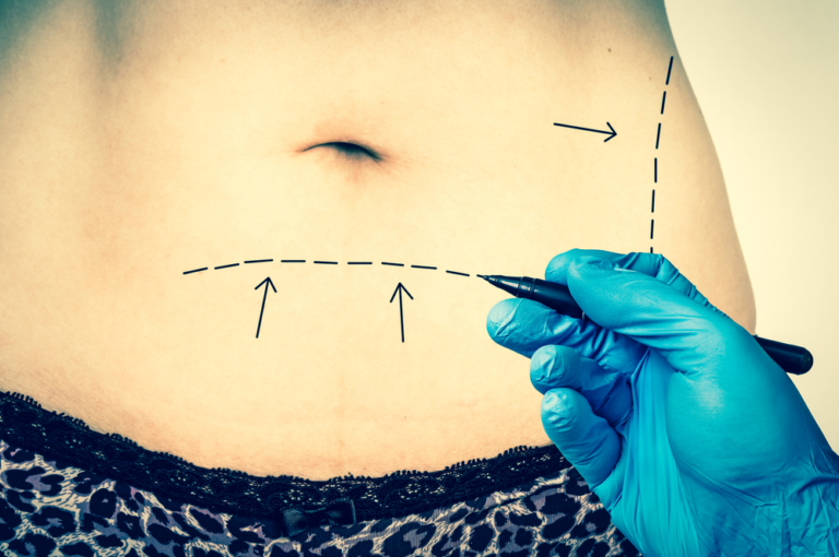 cost of tummy tuck cost of tummy tuck